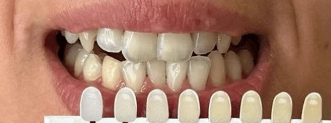 BEYOND fogfehérítés előtt