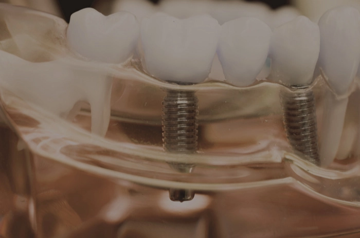 Fogászati implantátum